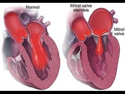 Insuficienta cardiaca a sugarului si a copilului